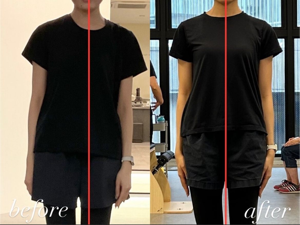 私が担当したお客様の姿勢改善ビフォーアフター